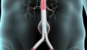 Abdominal Aortic Aneurysm Evaluation and Management