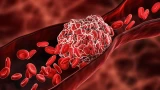 Deep Vein Thrombosis Evaluation & Management