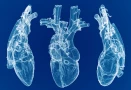 IVC Filter Placement and Removal